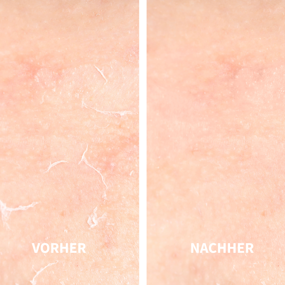 Vorher Nachher Vergleich schuppiger trockener Haut mit beruhigter und gepflegter wirkender Haut nach intensiver Pflege